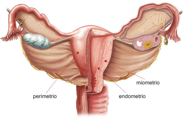 svorio metimas padeda endometriozei numesti svorio miežiai