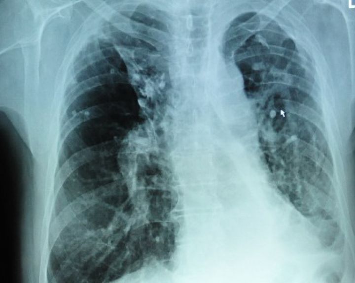 svorio netekimas sergant plaučių tuberkulioze